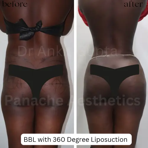 360° Liposuction result — Panache