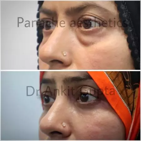 Blepharoplasty result — Panache