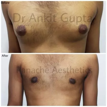 Gynecomastia surgery result — Panache